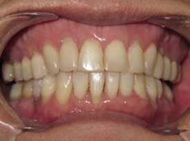 Before and After Functional Orthodontics St. Paul, MN